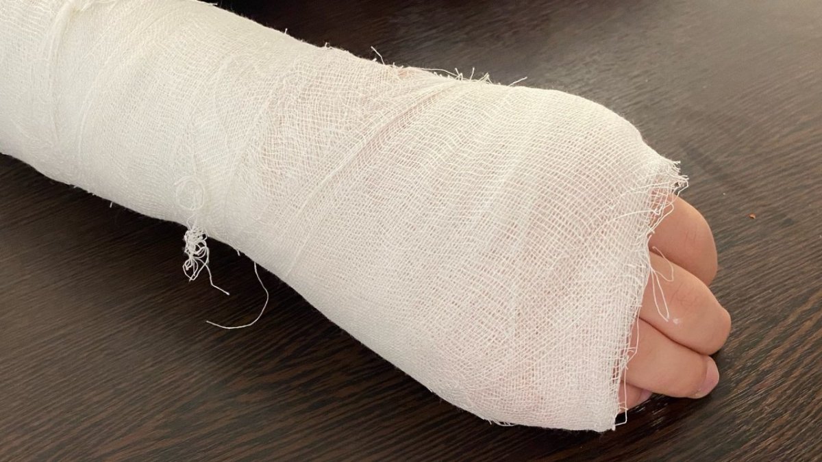 Рука замотонная в бинты и наложен кипс лежит на столе